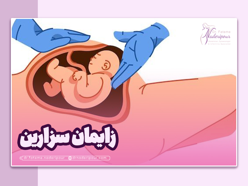 زایمان سزارین، هرچه باید در مورد آن بدانید