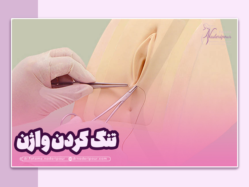 تنگ کردن واژن بعد از زایمان طبیعی