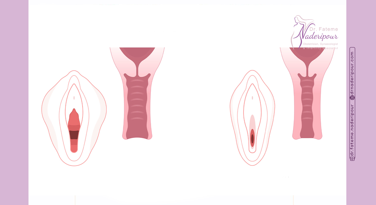 نکات مراقبتی بعد از جراحی واژینوپلاستی