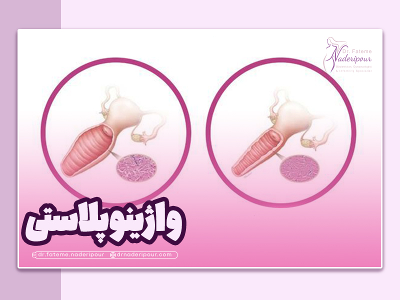 تنگ کردن واژن یا واژینوپلاستی چیست؟
