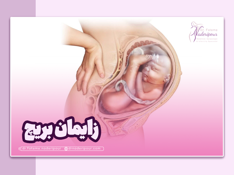 علل و عوامل خطر زایمان بریچ