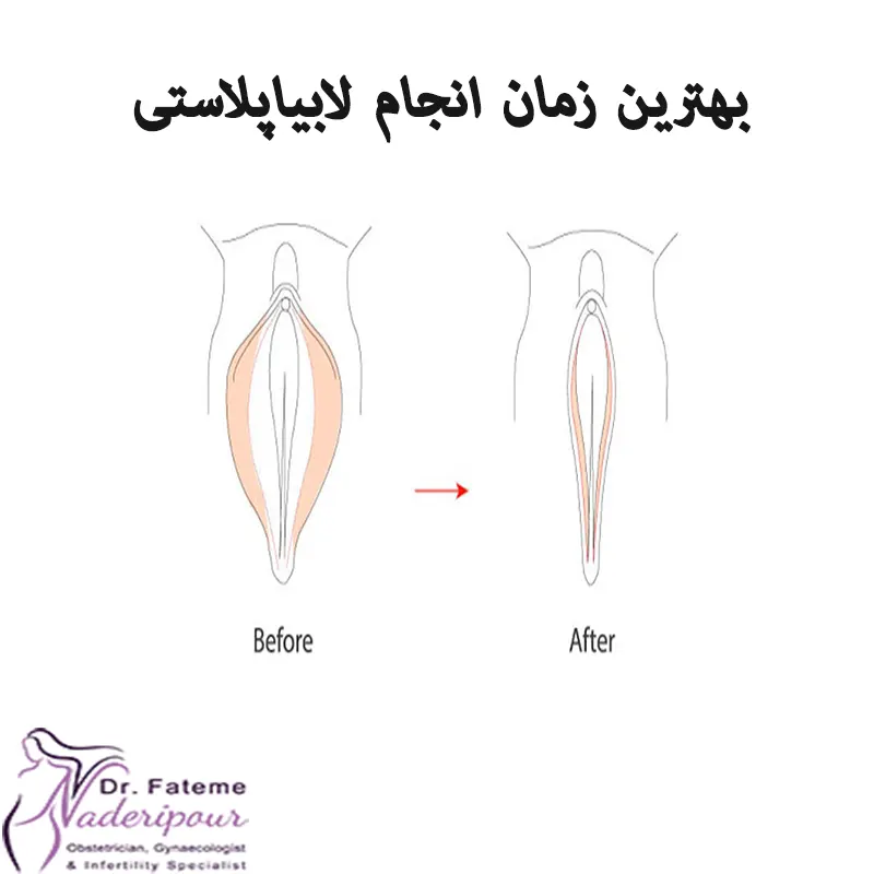 بهترین زمان انجام لابیاپلاستی