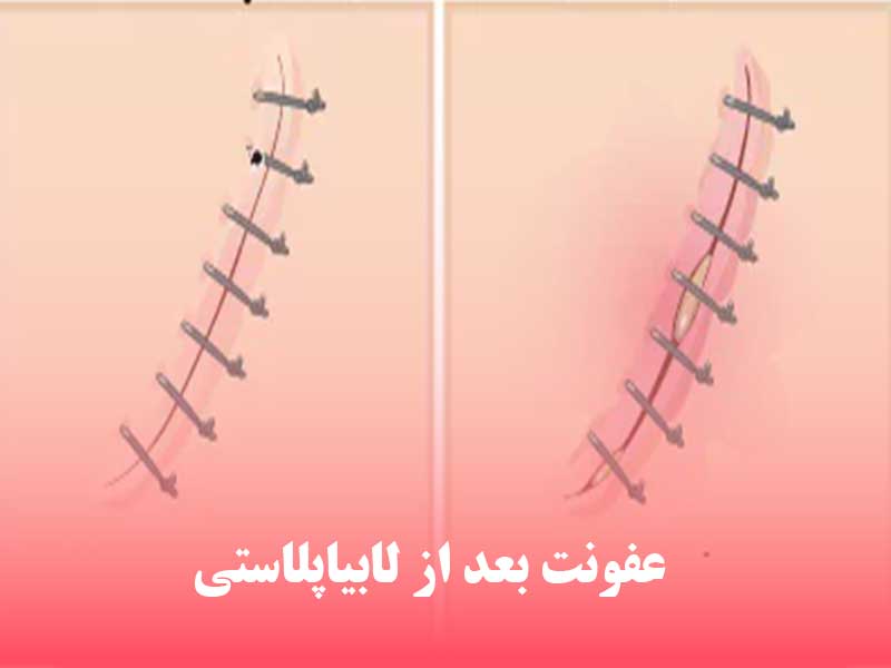 عفونت بعد از لابیاپلاستی