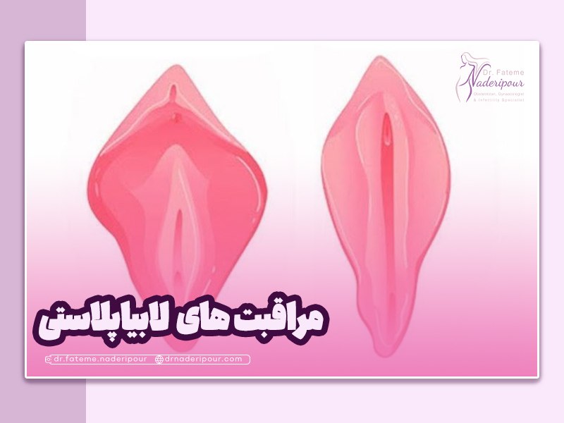 مراقبت های بعد از جراحی لابیاپلاستی