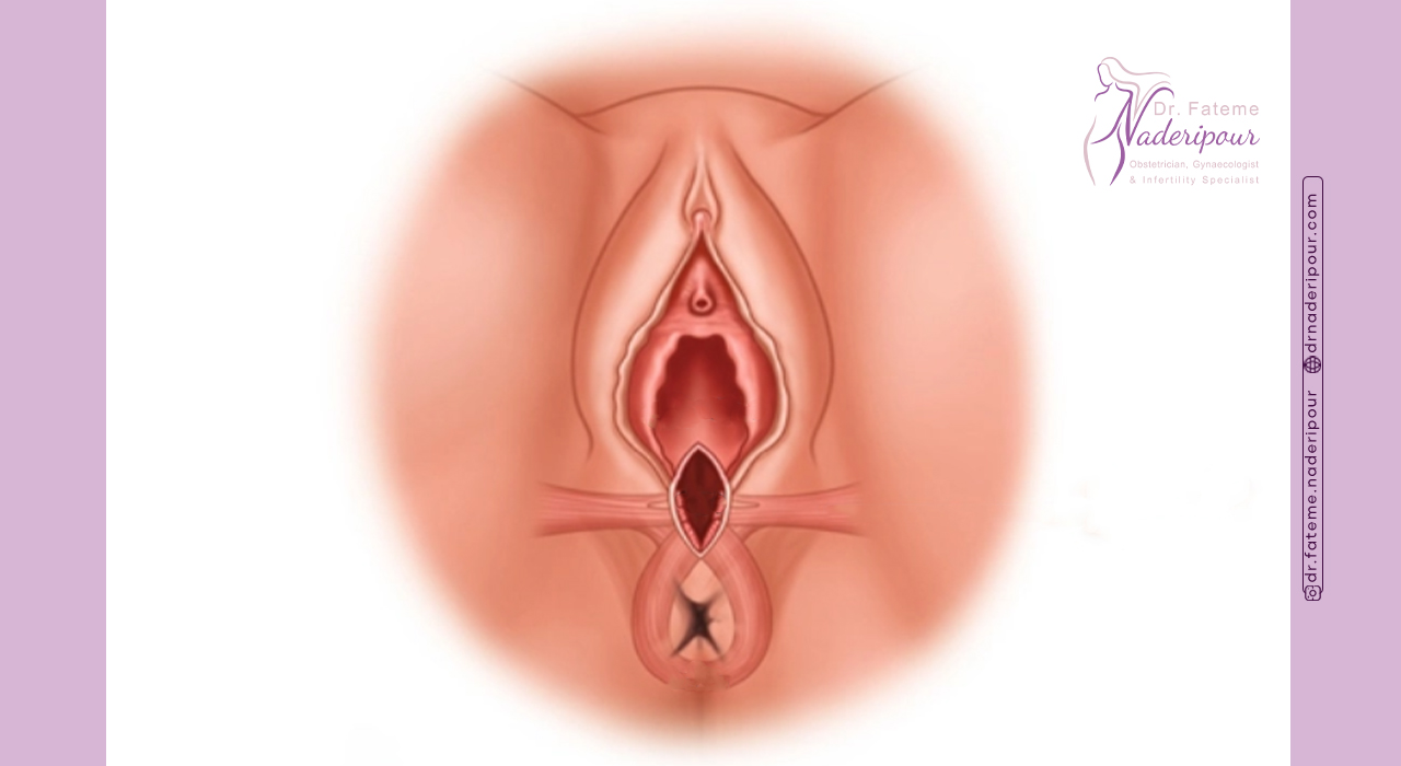 مراقبت های بعد از پرینورافی