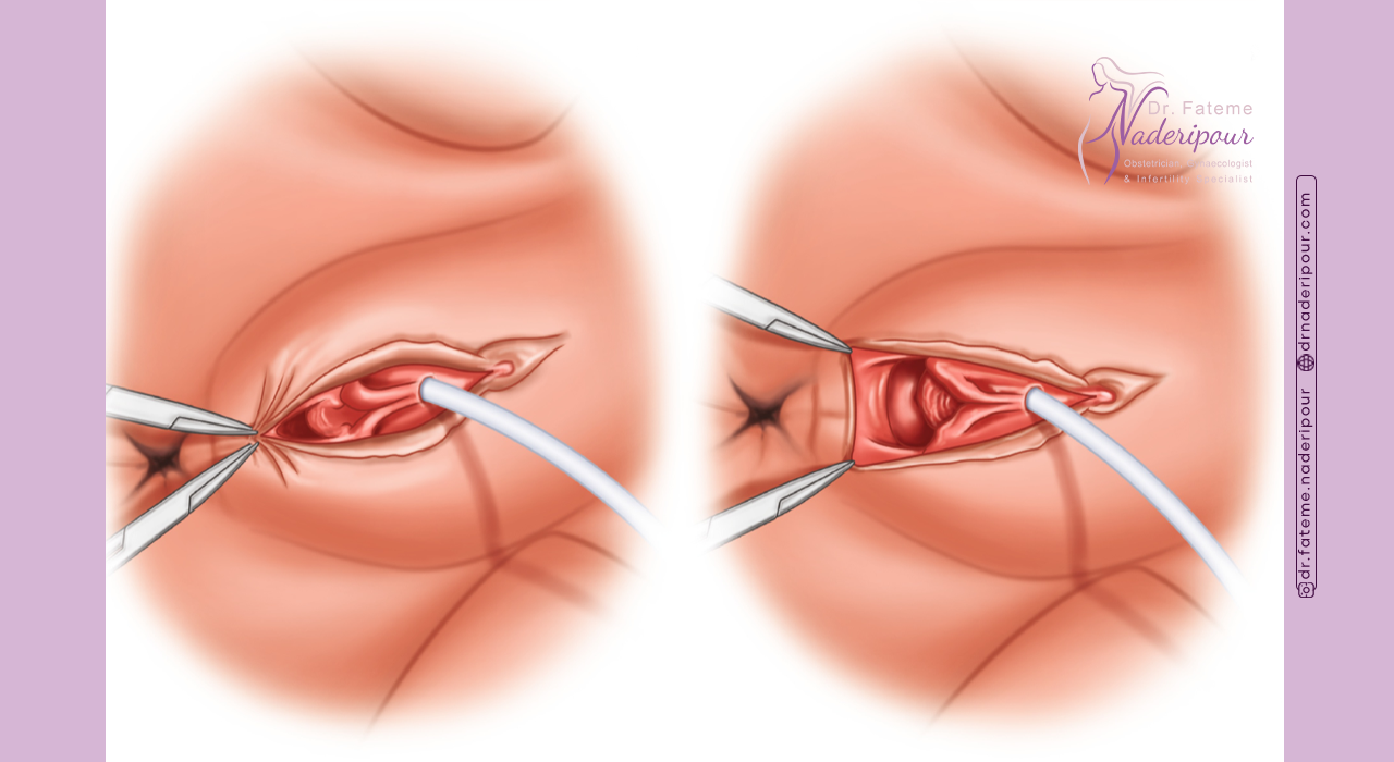 هزینه جراحی پرینورافی در سیرجان