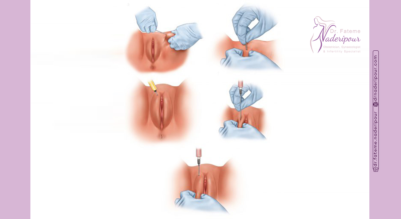 مراحل تزریق چربی به واژن چگونه است؟