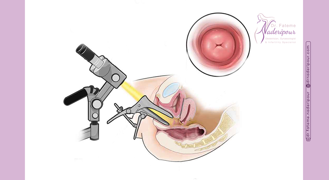 مراقبت های بعد از انجام کولپوسکوپی