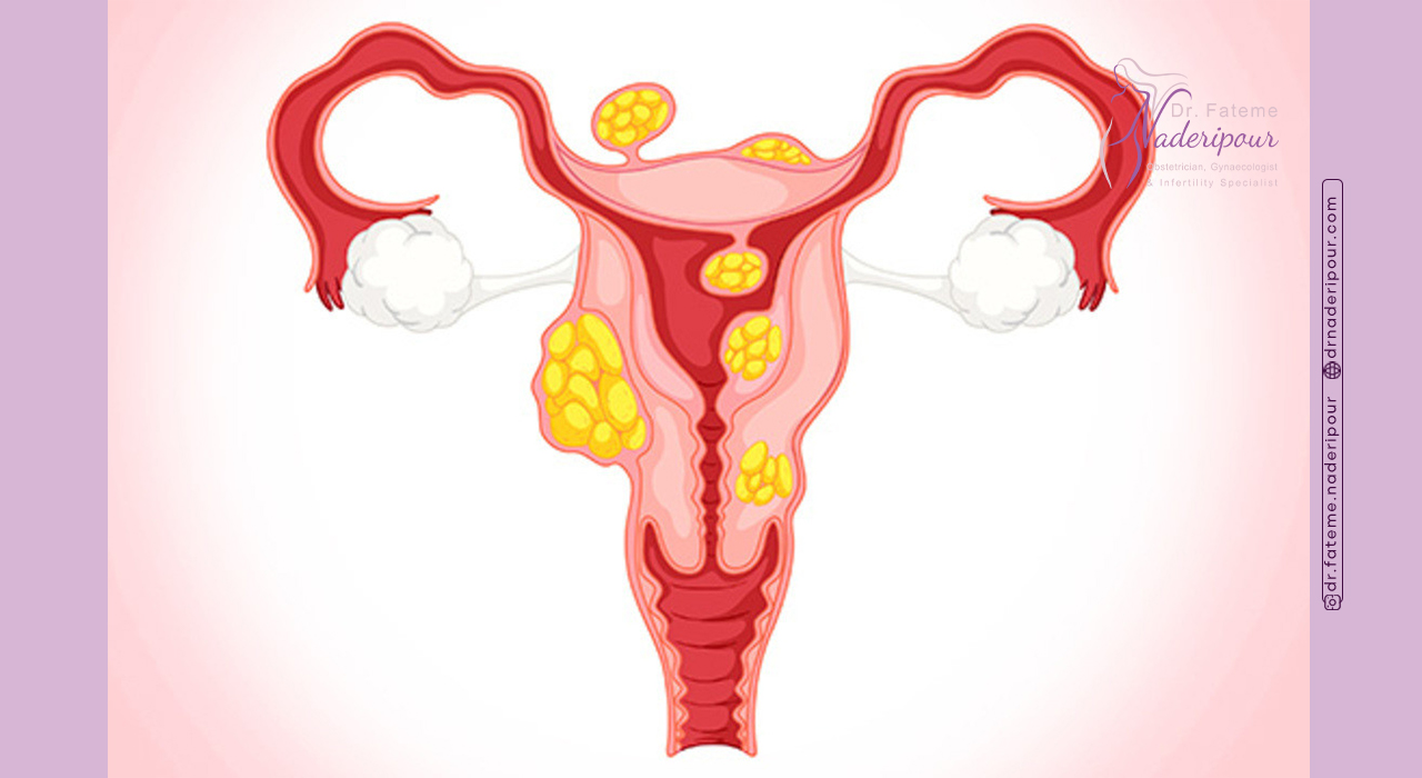 چه کسانی در معرض خطر ابتلا به فیبروم هستند؟