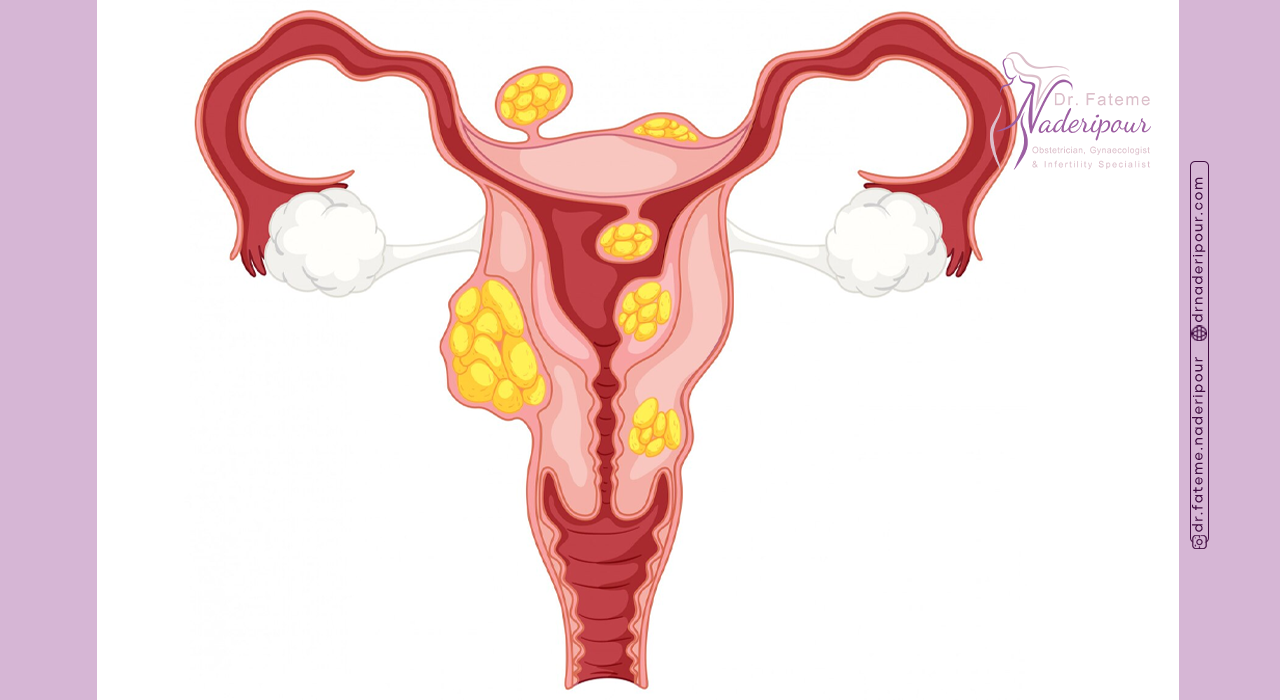 علت ایجاد پولیپ رحم چیست؟