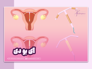 آی یو دی چیست؟