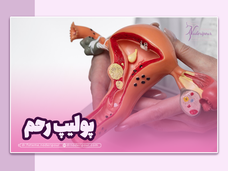 پولیپ رحم چیست؟